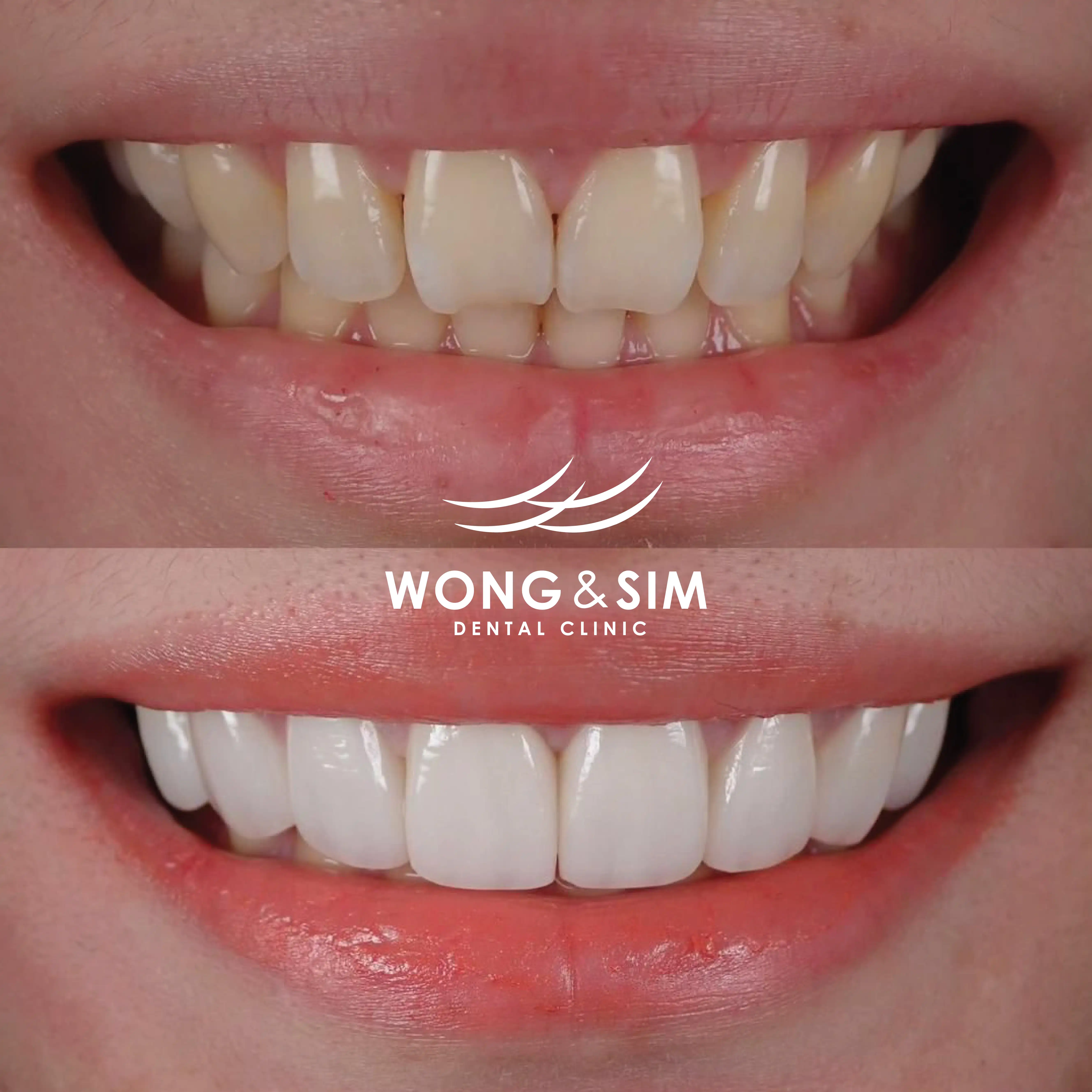 Patient 4 - Braces Before and After